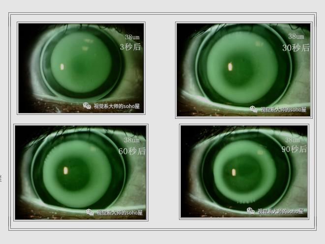 视光冷知识|OK镜的荧光评估靠谱吗？