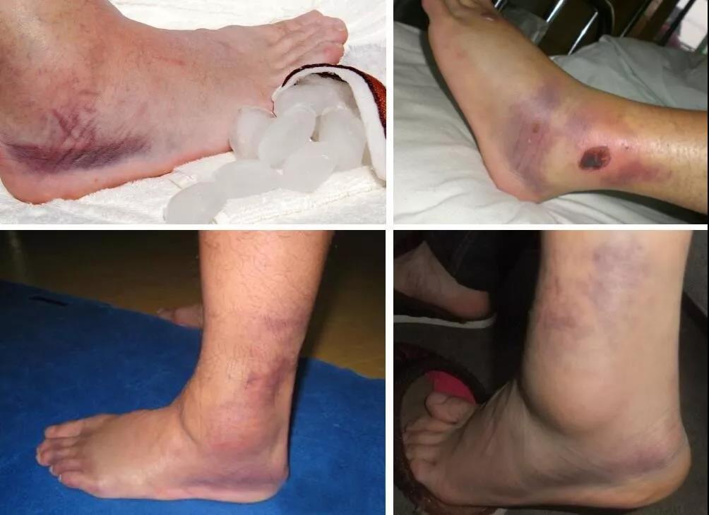 跑步后腿疼脚疼是怎么回事,跑步后腿脚痛如何缓解