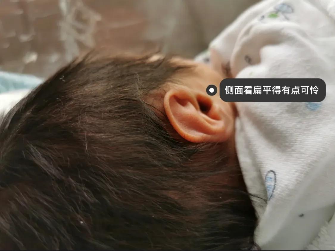 宝宝出生耳廓畸形但是听力正常,刚出生宝宝畸形耳朵图片