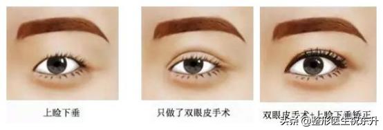 矫正上睑下垂的手术没有效果,上睑下垂矫正手术后听到嘣的一声