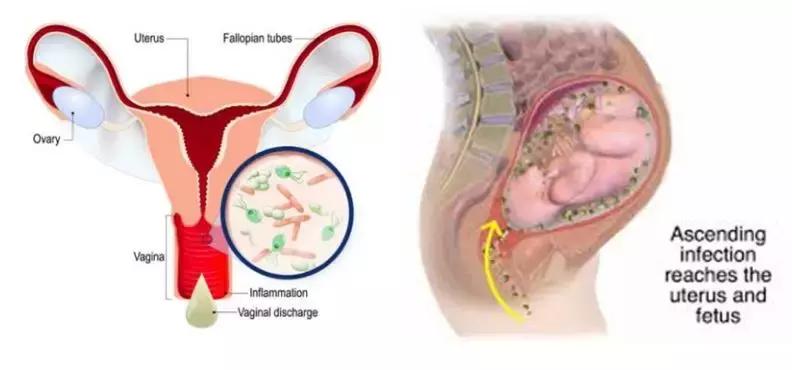 陈超：妇科病原微生物高通量快速检测和精准治疗
