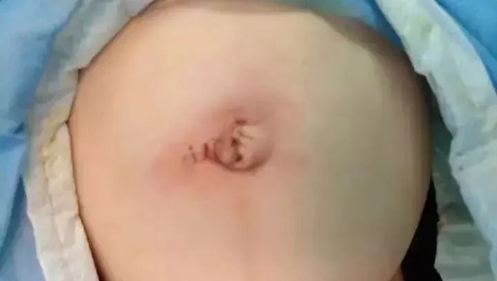 宝宝肚脐鼓起一个大包,宝宝肚脐鼓包