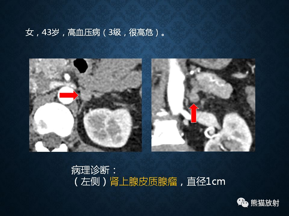 纵隔和肾上腺恶性肿瘤,纵隔性肿瘤位置图