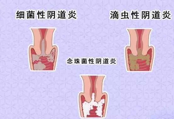 妊娠合并细菌性阴道炎用什么药,妊娠性阴道炎