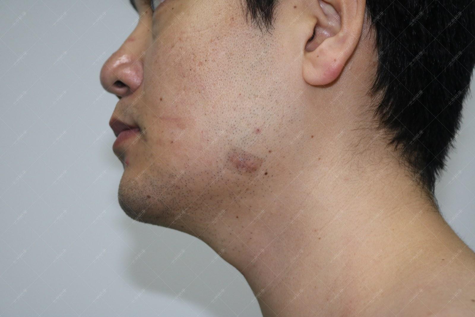 疤康疤痕疙瘩治疗效果怎么样,疤康治疗效果是真实的吗