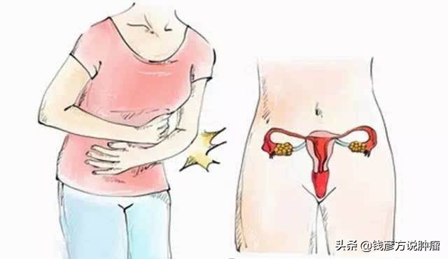 孕期如何预防宫颈息肉出血,宫颈息肉手术后如何预防复发