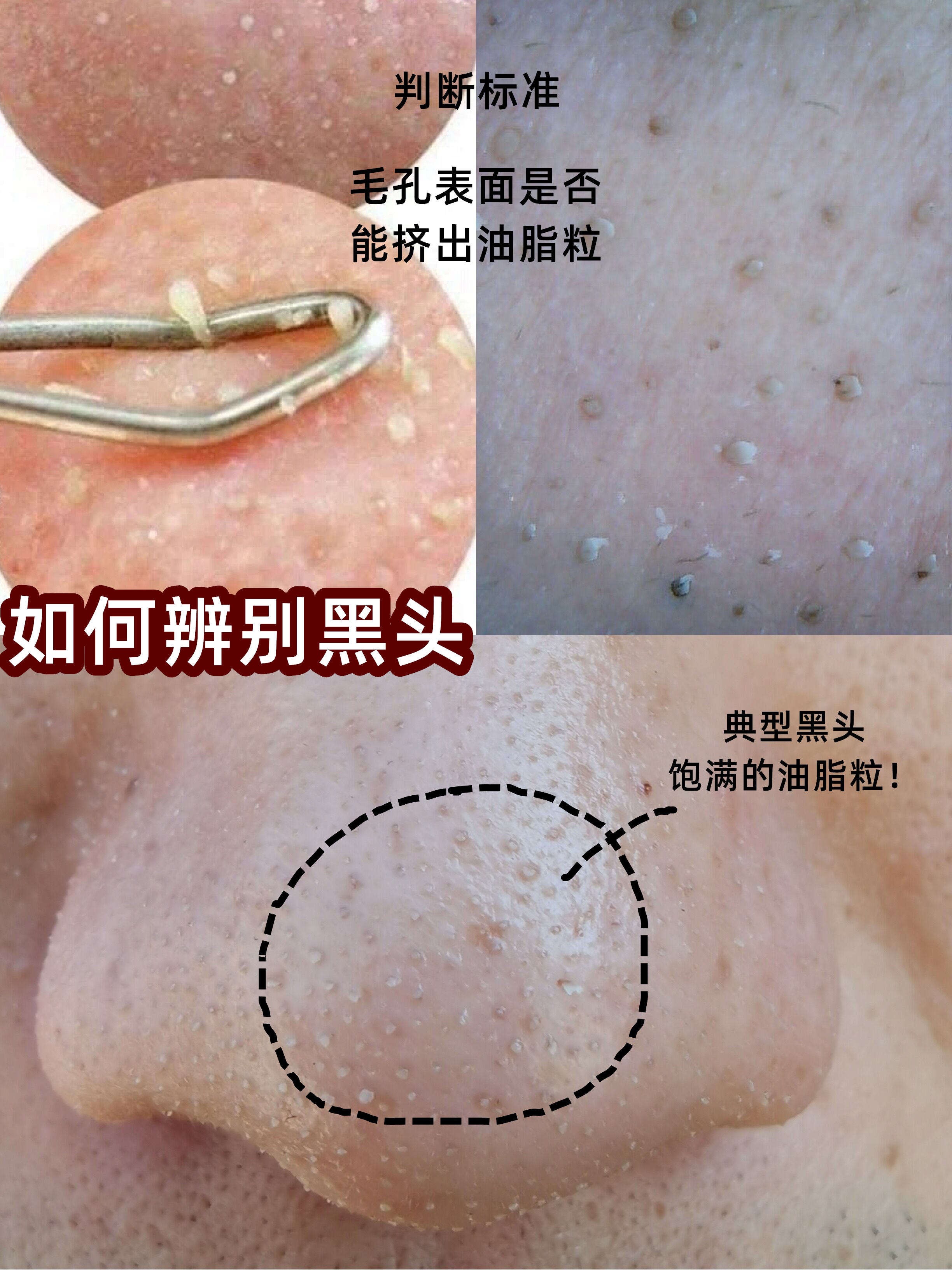 黑头如果不管的话会怎样,如果不清理黑头会怎样