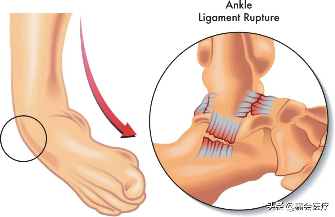 脚踝损伤怎么快速消肿,脚踝损伤怎样有利于恢复