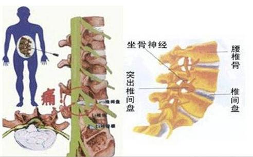 腰椎间盘突出脚麻难治,腰间盘突出和脱出哪个难治