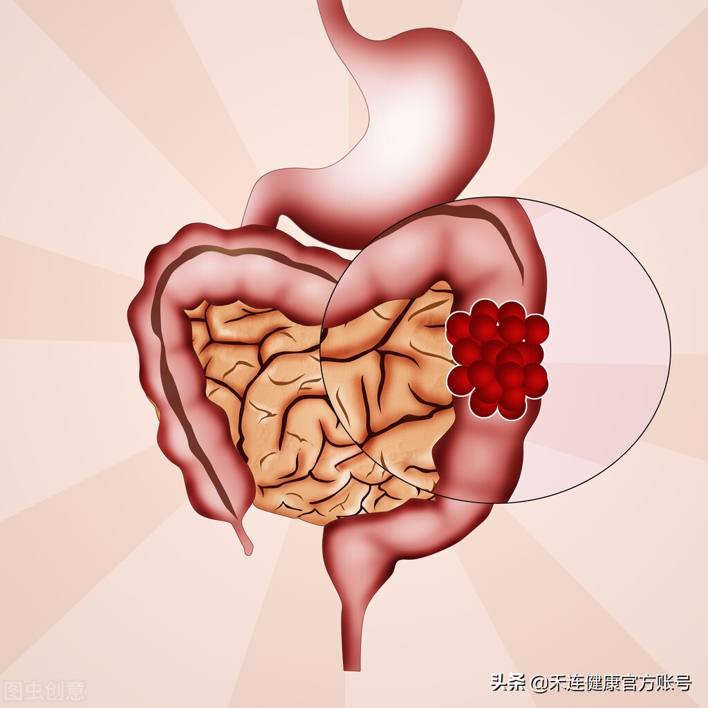 预防胃癌和肠癌吃什么东西,吃哪些东西会引起胃癌和肠癌