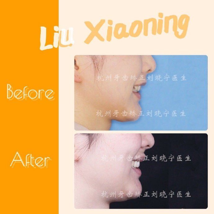 杭州舌侧牙齿矫正,舌侧矫正杭州价格