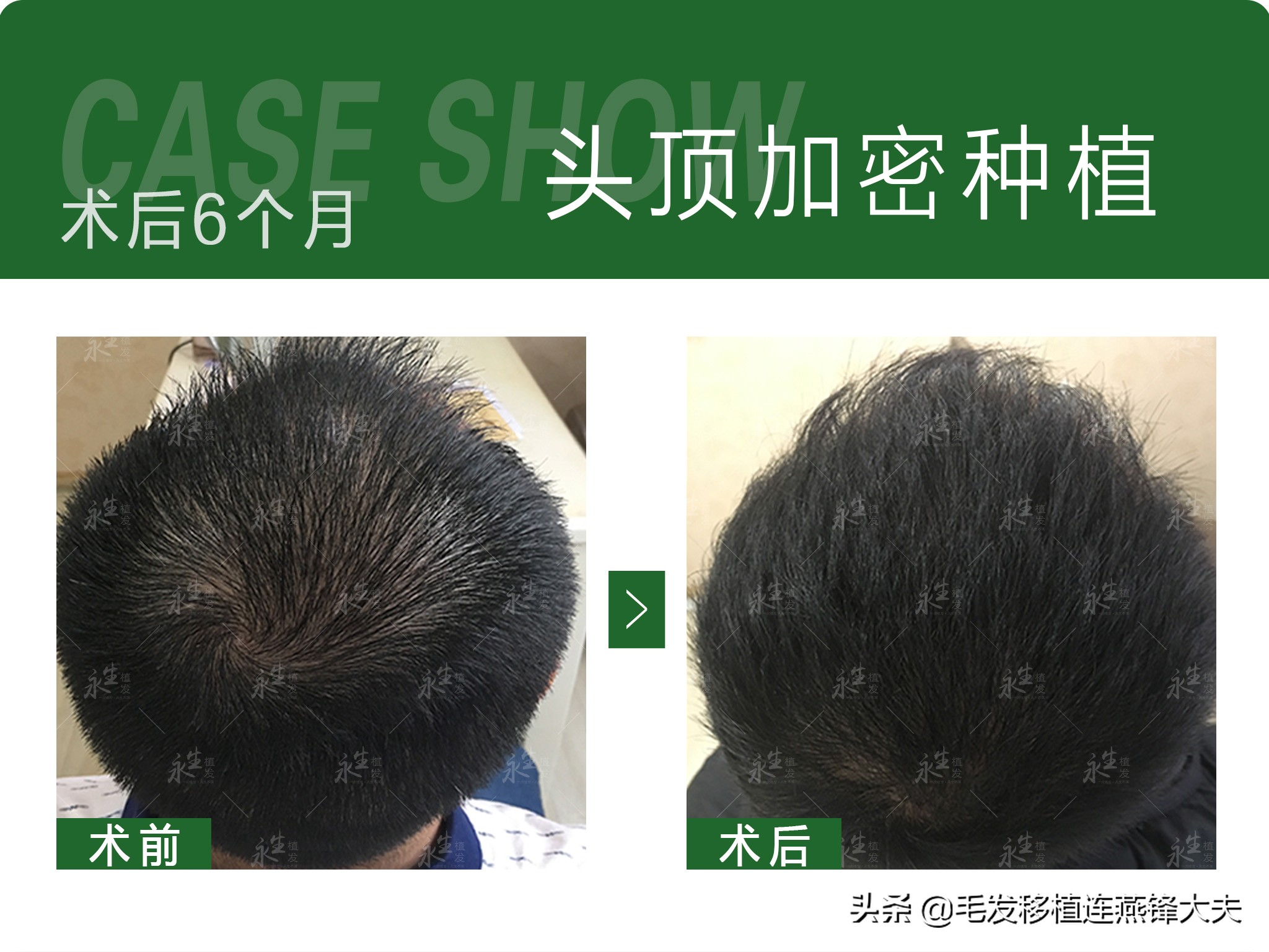 脱发2年,脱发一年了头发明显减少