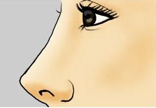 鼻整形增生恢复了鼻子会小吗,鼻整形术后鼻子会肿吗