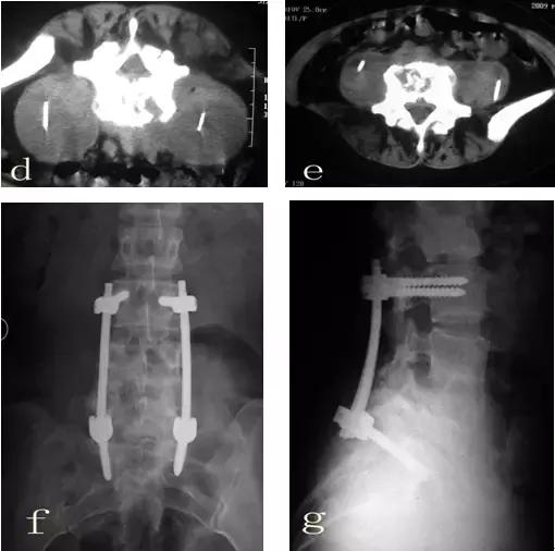 腰椎结核吃什么药疗效快,腰椎结核简短介绍