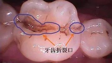 牙齿出现了隐裂有点酸感怎么办,牙齿隐裂不杀神经直接做牙套