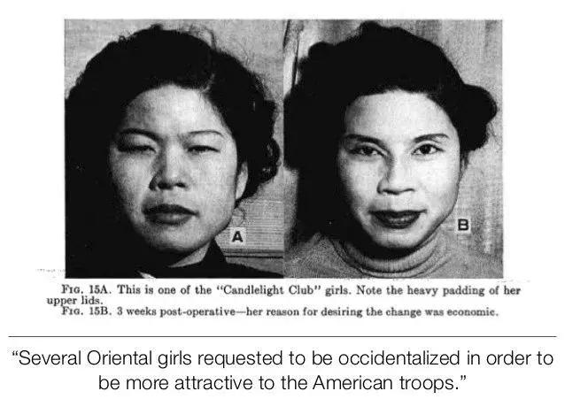 双眼皮真的有那么漂亮吗,自然双眼皮和割的双眼皮内在区别