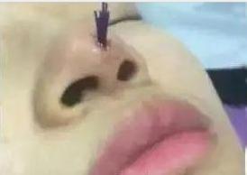 线雕隆鼻能维持几年还是那么挺,线雕隆鼻真的能吸收吗