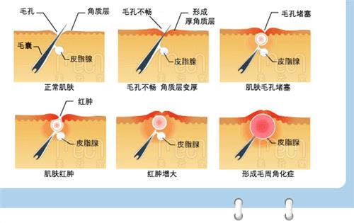 毛周角化症鸡皮肤怎么治疗最有效,鸡皮肤毛囊角质怎么去除最有效
