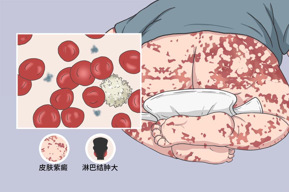 过敏性紫癜是多大的年龄发病,过敏性紫癜得病的原因和危害性