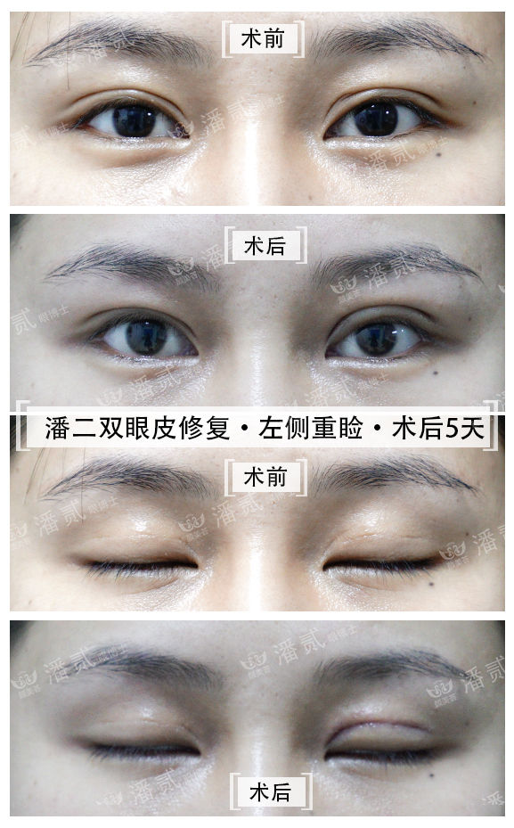 韩式三点式双眼皮手术很疼吗,韩式三点双眼皮做的不好看