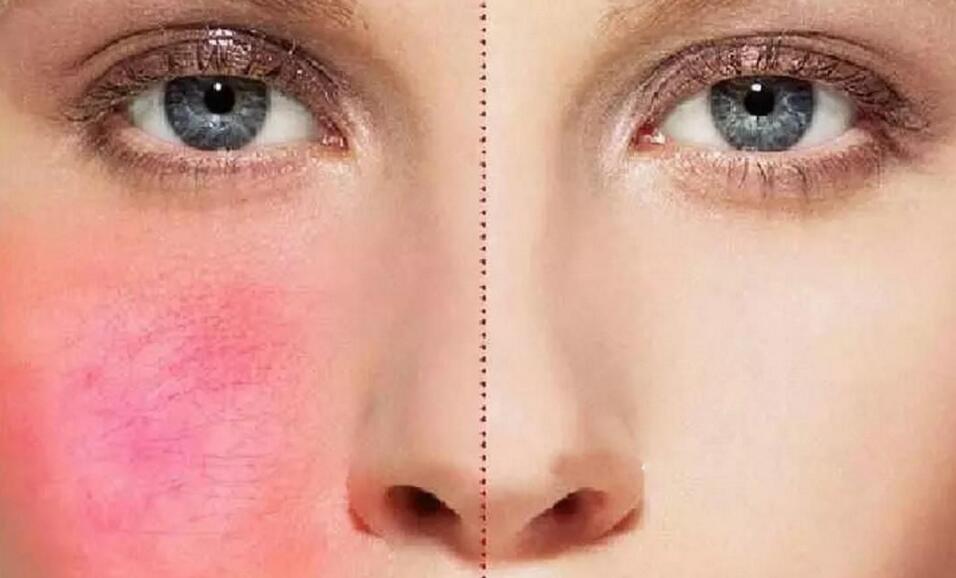 血丝脸最快的修复方法,怎样有效改善红血丝面部发红