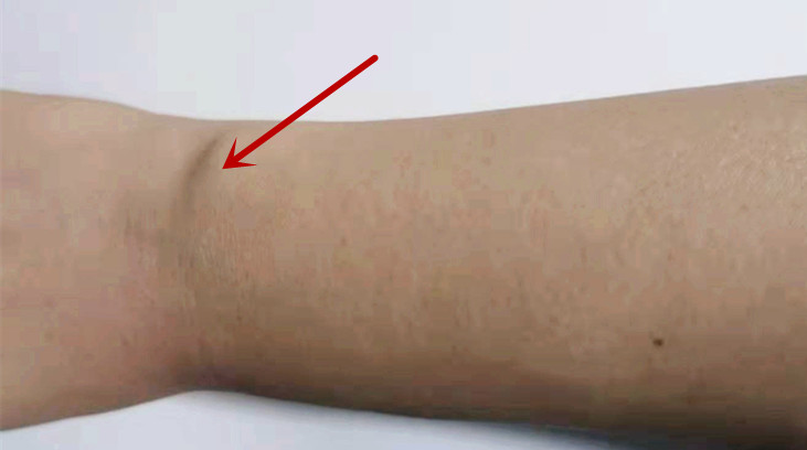 脚腕扭伤了怎么快速止痛,脚腕扭伤消炎止痛