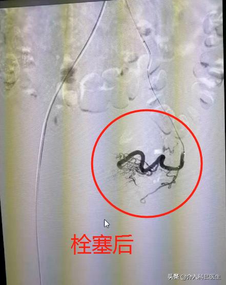 她因不堪子宫腺肌症折磨，专程从国外飞回来，接受这项微创疗法