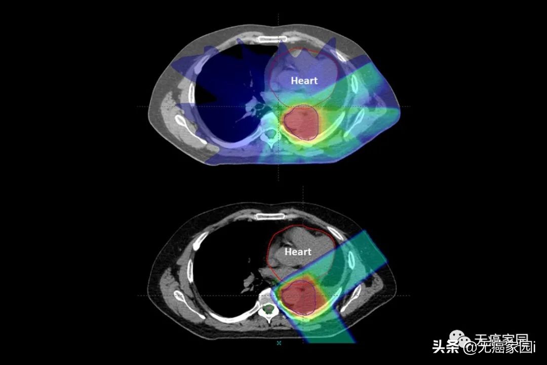 头部肿瘤质子放疗长期毒副作用,质子放疗对什么肿瘤效果不明显
