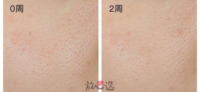 城野医生毛孔细致水去闭口吗,城野医生毛孔细致水一周用几次