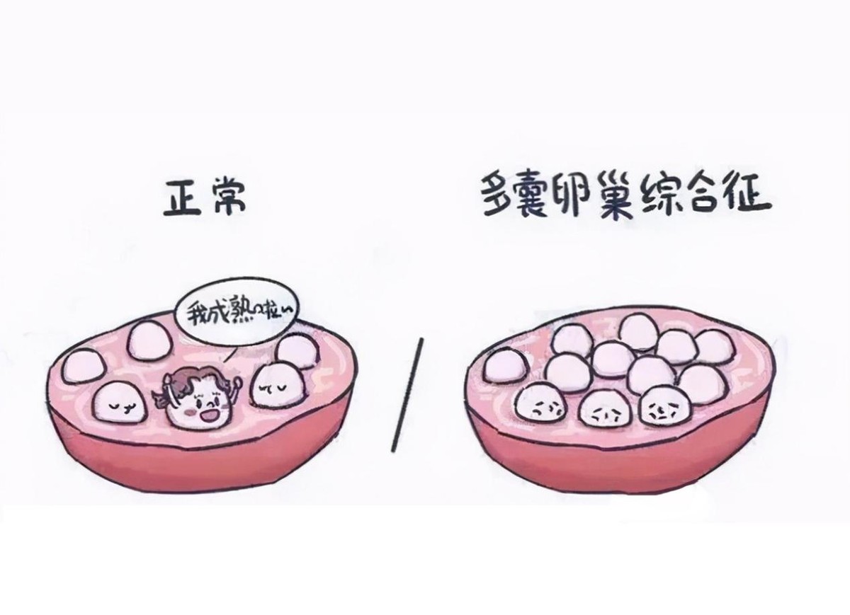 宫外孕是宫颈癌的前兆吗,宫外孕有什么信号吗