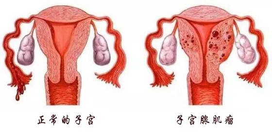 有这7个特点的女人，很容易得子宫腺肌症