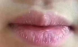 唇炎反复红肿发痒灼热怎么治疗,引起唇炎的原因