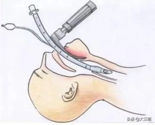 医疗•技术｜三明市永安总医院麻醉医师成功征服困难气道，助力妇科微创手术