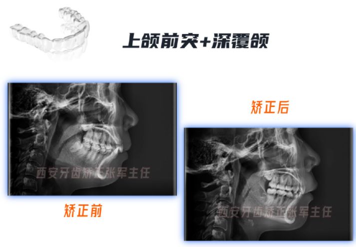 牙齿矫正雁塔区,矫正牙齿拔掉4颗智齿