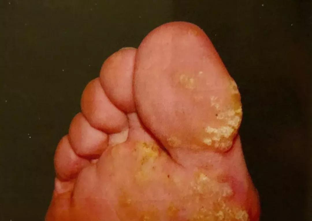 脸上长了像黑痣一样的东西,脸上长了像痘痘的东西是啥