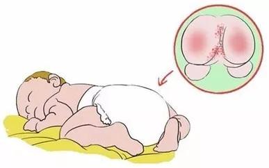 怪不得宝宝总是红屁屁，原来是这里出了问题！