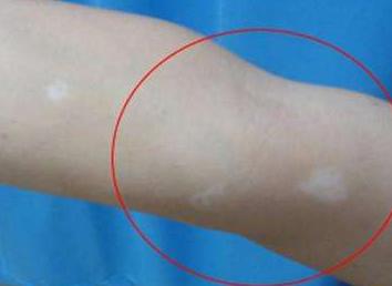 患白癜风的女生能用哪些化妆品,脱毛膏会引起白癜风吗