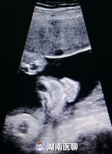 孕检四维五维,怀孕做了四维还要做二维三维吗