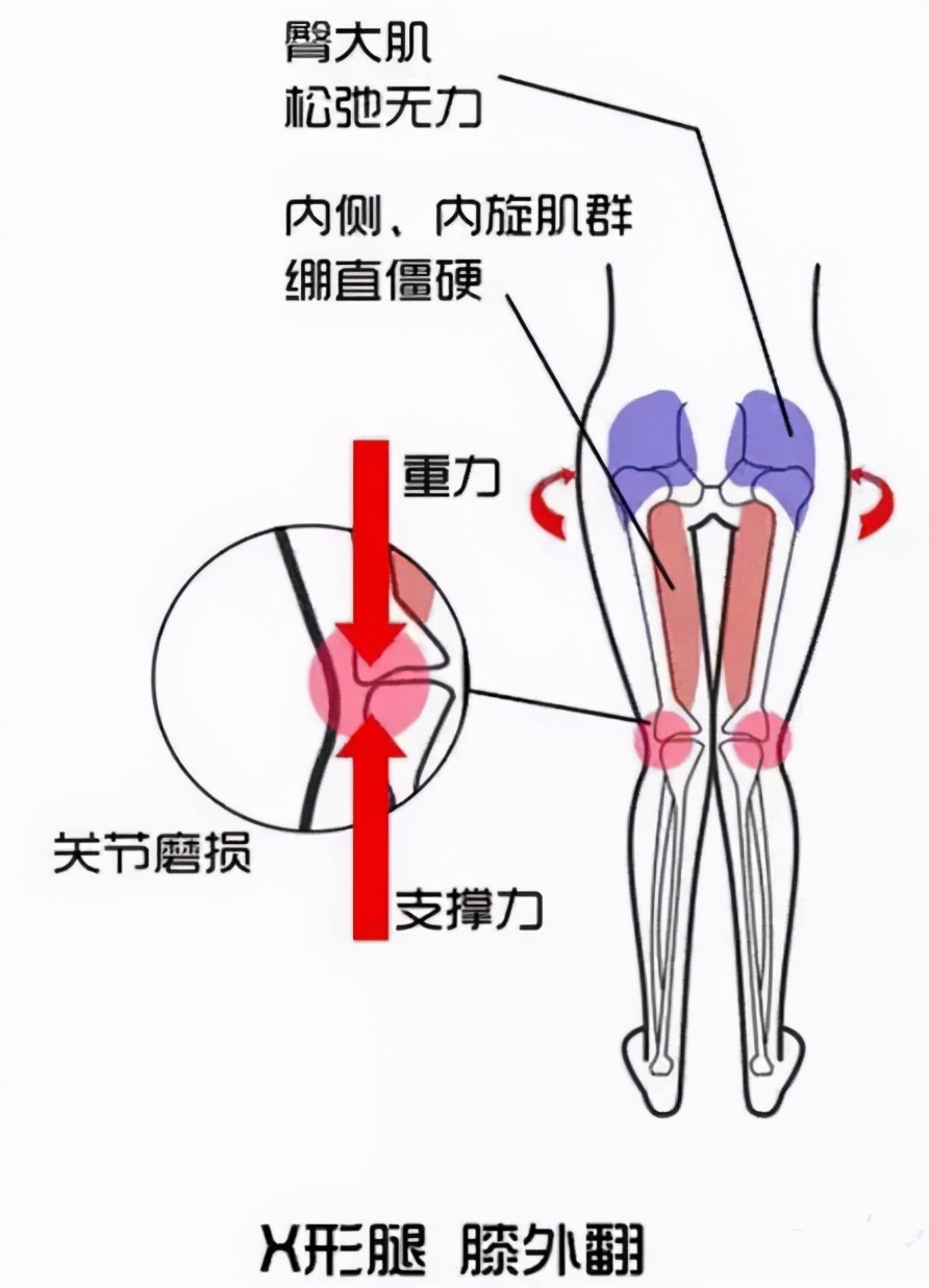 x腿型矫正十种让腿变直的方法,腿不直怎么矫正腿型