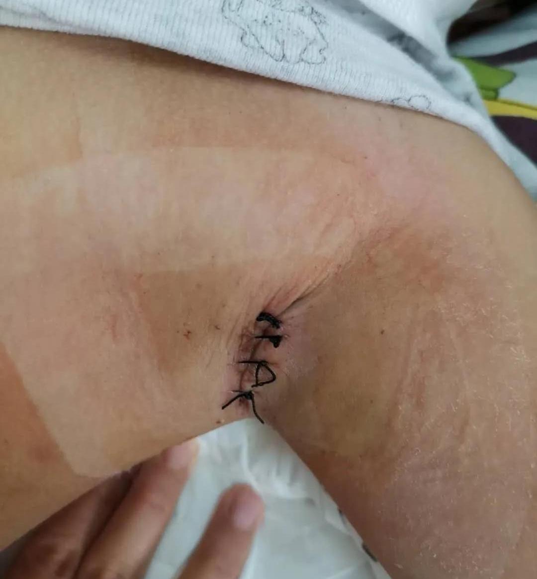 小孩腋下附近疼痛,儿童腋下肿大疼痛