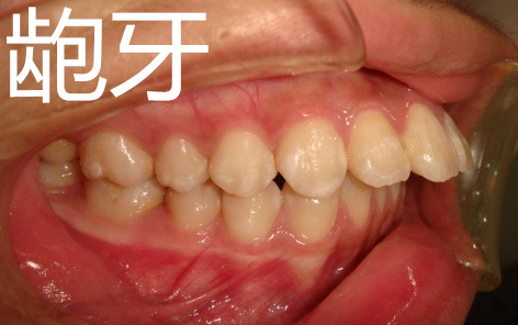 30岁了还可以做牙齿矫正吗,30岁还可以做牙齿矫正吗