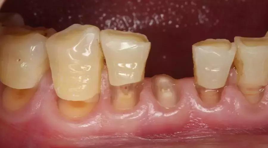 牙齿顶端小凹槽,牙齿出现楔状沟槽