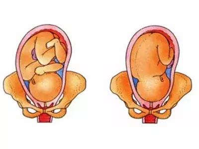 孕妇胎位不正多少周纠正胎位,胎位不正臀位纠正操37周