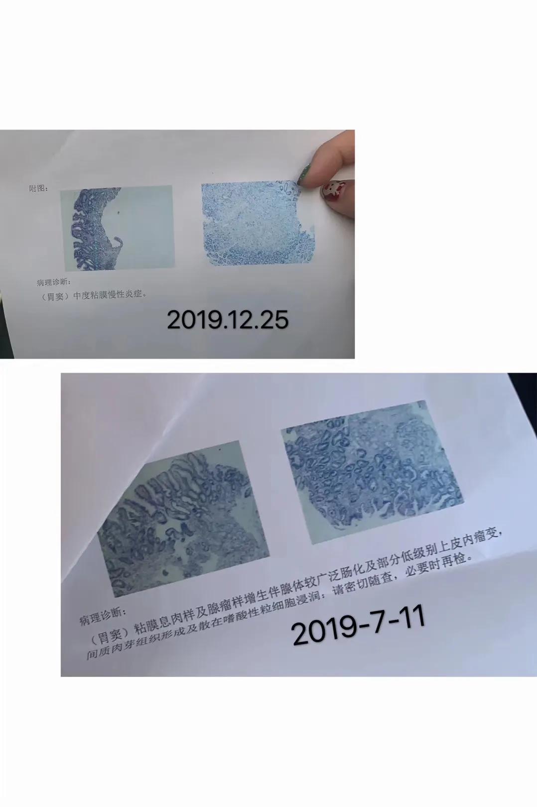 分享一个治好我胃病的食疗方法,成功治愈胃病的经历分享