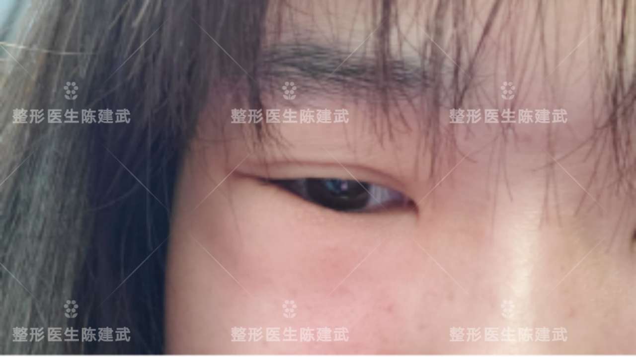 同姐妹们分享：天生肿泡眼，割完眼袋后，竟然要二次修复？