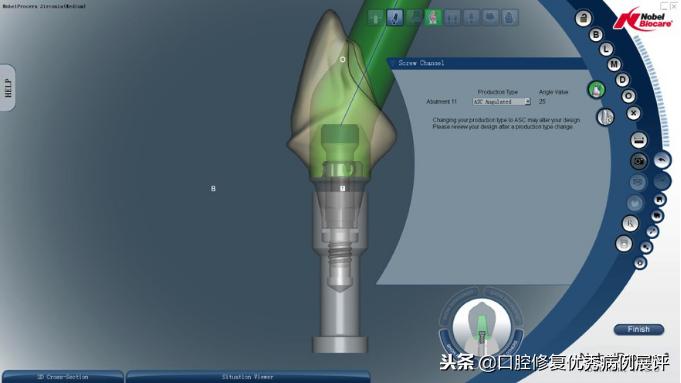 展评优秀病例赏析|Asc全瓷角度基台一体冠进行种植前牙美学修复