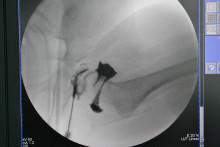 儿童发育性髋脱位表现,发育性髋关节脱位治疗4-7岁