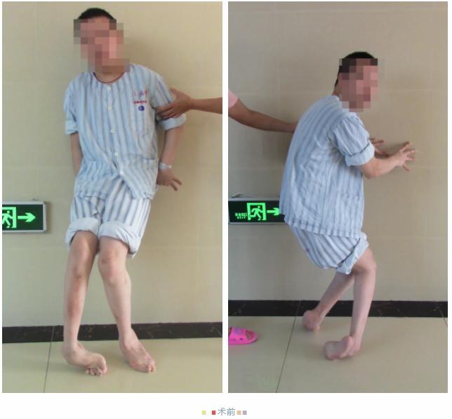 ilizarov技术演示,ilizarov技术手术步骤