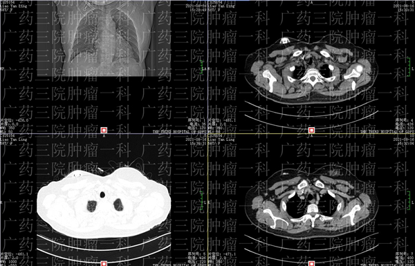广药三院肿瘤一区靠谱吗,广药三院肿瘤成功案例