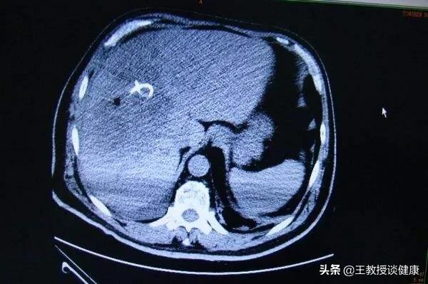 脓肿为什么会有硬结,肝脓肿和糖尿病的关系